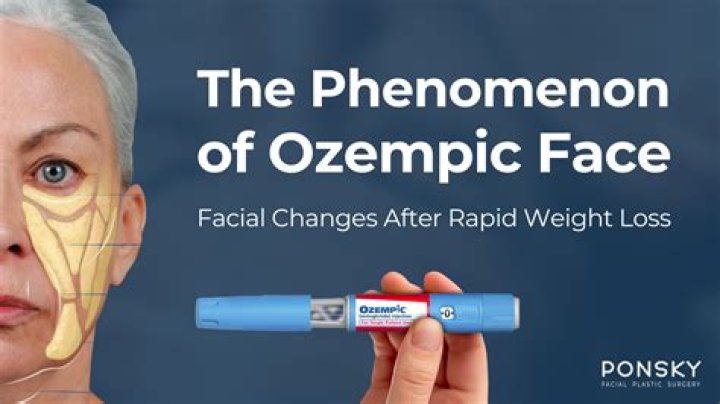 Can Someone With Lupus Take Ozempic? Understanding The Connection